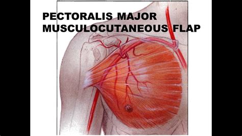 pectoralis major lappen|5.1: Pectoralis Major Flap